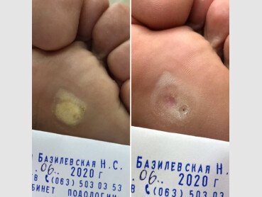 Результат видалення мозолів №2