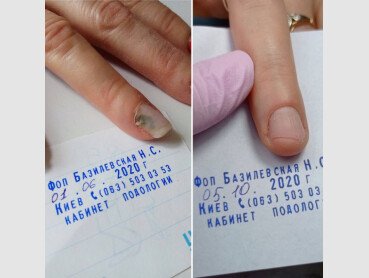 Результат відновлення відшарованих нігтів (Оніхолізис) №3